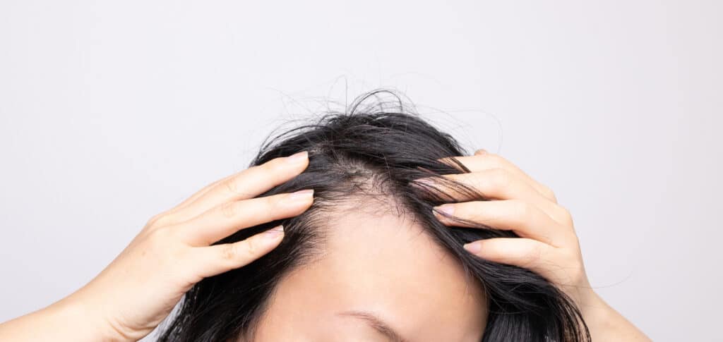 effective ways for stop female receding hairline