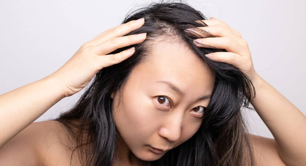 Cause of Hair Thinning in Females