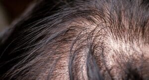 hair thinning in females