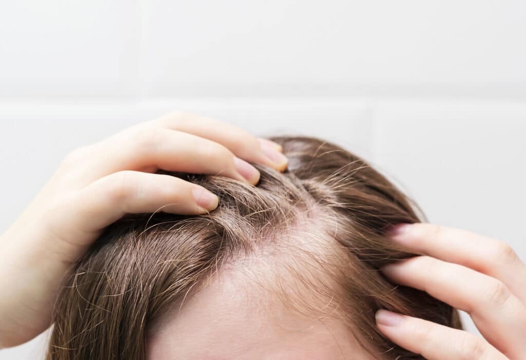 itchy scalp and hair loss