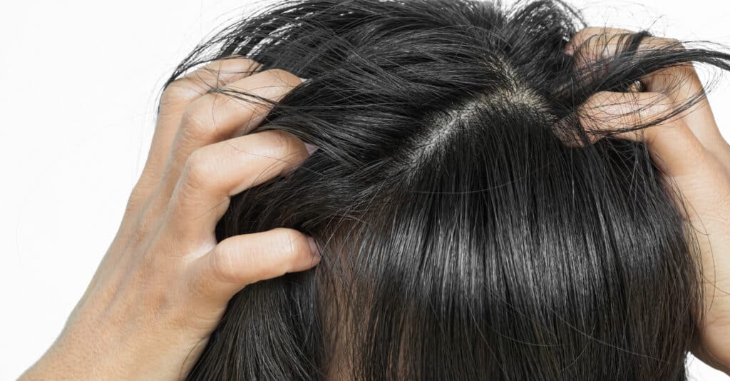 itchy scalp and hair loss in women