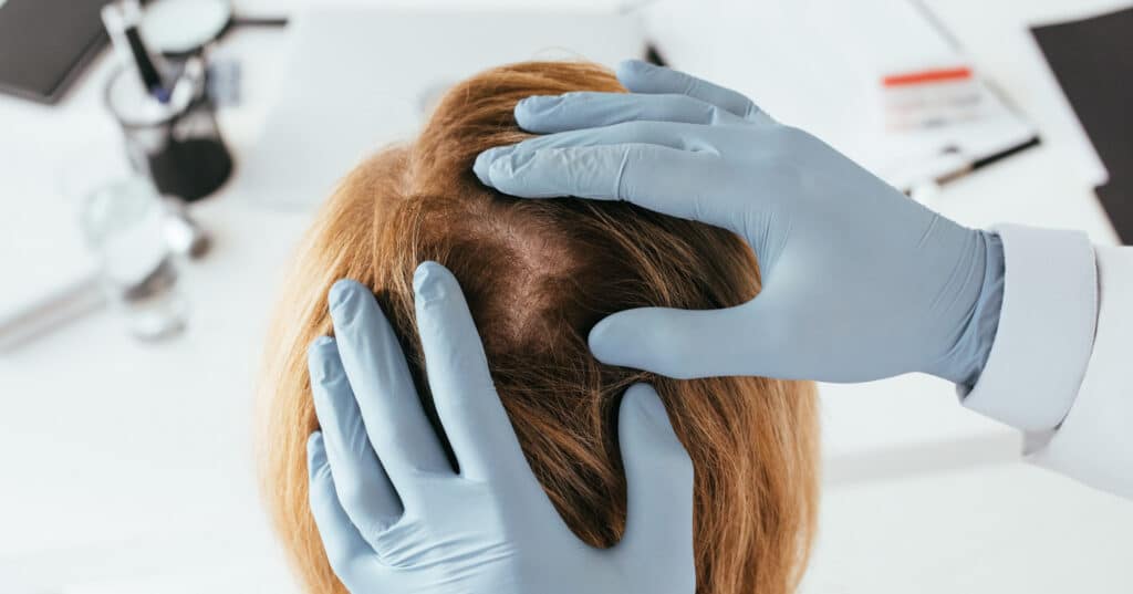 Hair Thinning at Back of Head Female - Causes and Treatments