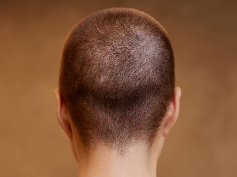 Hair Thinning at Back of Head Female - Tips and Remedies