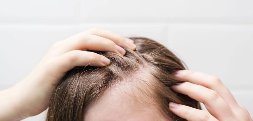 Hair Thinning at Temples - Effective Steps for Full Hair