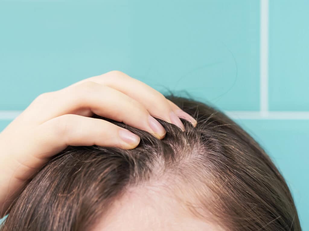 Hair Thinning at Temples - Powerful Solutions for Full Hair