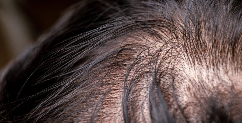 thinning hair on top of head female - causes