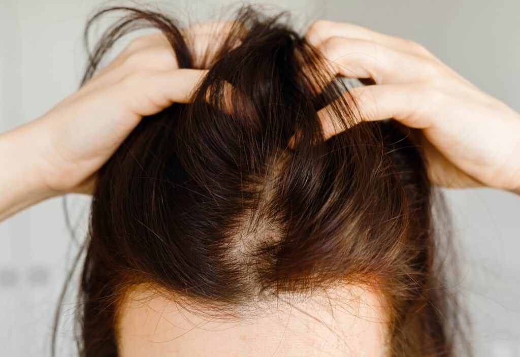 thinning hair on top of head female - causes and remedies