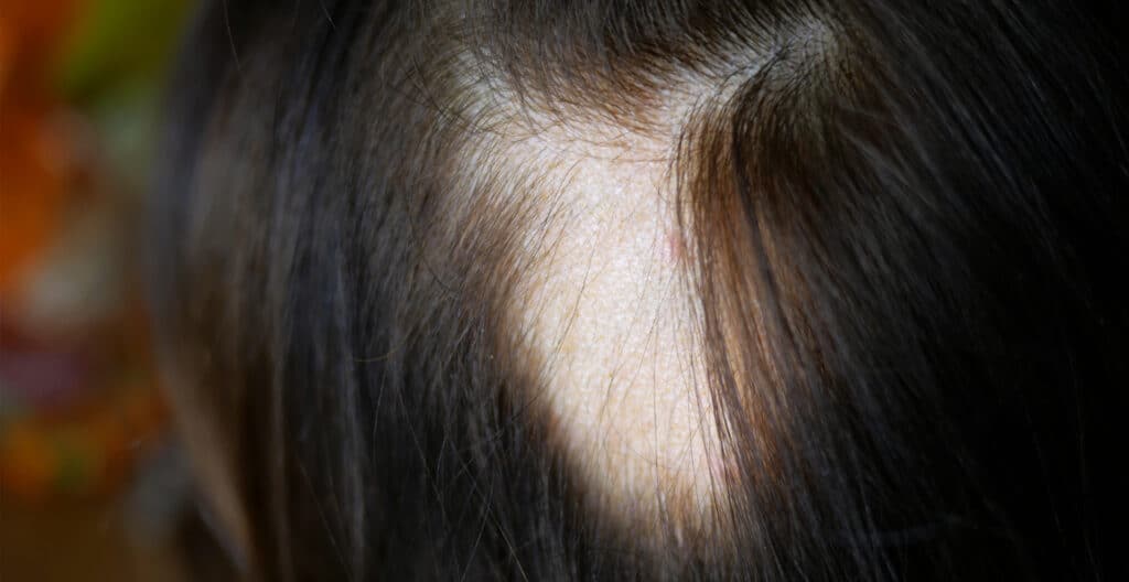 thinning hair on top of head female - remedies