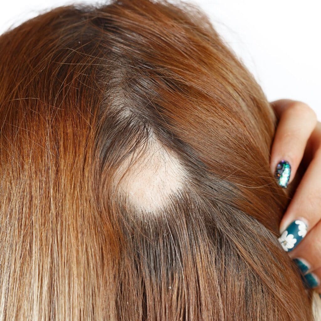 Best Alopecia Treatment for Women That Works